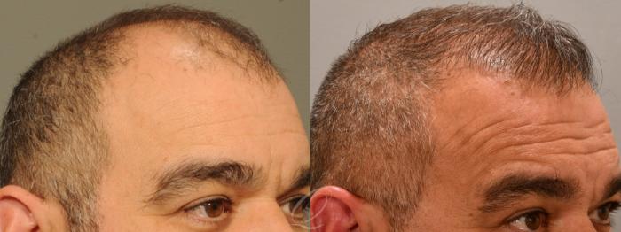 Before & After Male Hairline and Central Density Hair Restoration Case 1001688 Right Oblique View in Rochester, Buffalo, & Syracuse, NY