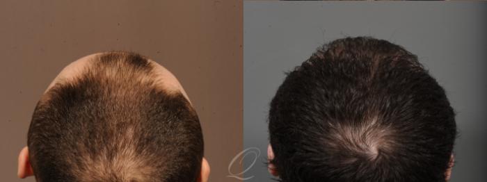 Male Hairline and Central Density Hair Restoration Case 1001689 Before & After Back | Serving Rochester, Syracuse & Buffalo, NY | Quatela Center for Plastic Surgery