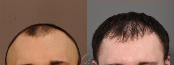 Male Hairline and Central Density Hair Restoration Case 1001689 Before & After Front | Serving Rochester, Syracuse & Buffalo, NY | Quatela Center for Plastic Surgery