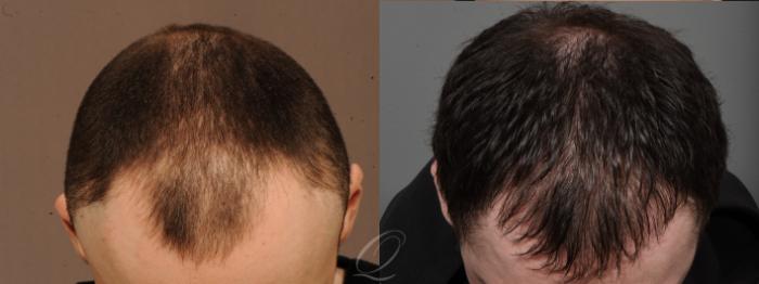 Before & After Male FUE Hair Transplant Case 1001689 Head down View in Rochester, Buffalo, & Syracuse, NY