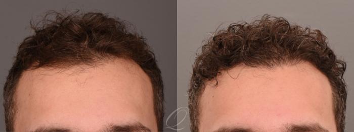 Male FUE Hair Transplant Case 1001690 Before & After Front | Serving Rochester, Syracuse & Buffalo, NY | Quatela Center for Plastic Surgery