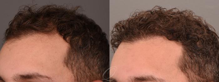 Male FUE Hair Transplant Case 1001690 Before & After Left Oblique | Serving Rochester, Syracuse & Buffalo, NY | Quatela Center for Plastic Surgery