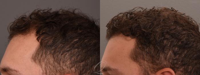Male FUE Hair Transplant Case 1001690 Before & After Left Side | Serving Rochester, Syracuse & Buffalo, NY | Quatela Center for Plastic Surgery