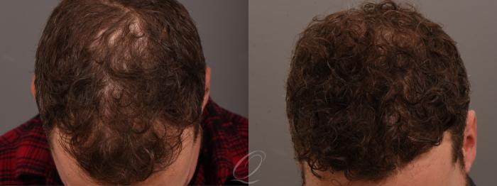 Male FUE Hair Transplant Case 1001690 Before & After Top View | Serving Rochester, Syracuse & Buffalo, NY | Quatela Center for Plastic Surgery