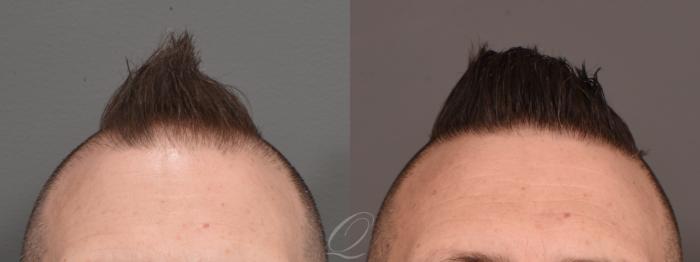 Male FUE Hair Transplant Case 1001691 Before & After Front | Serving Rochester, Syracuse & Buffalo, NY | Quatela Center for Plastic Surgery