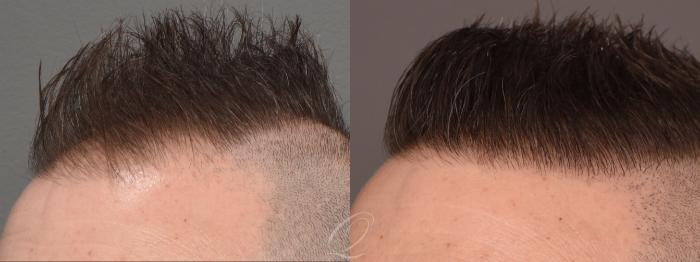 Male FUE Hair Transplant Case 1001691 Before & After Left Oblique | Serving Rochester, Syracuse & Buffalo, NY | Quatela Center for Plastic Surgery