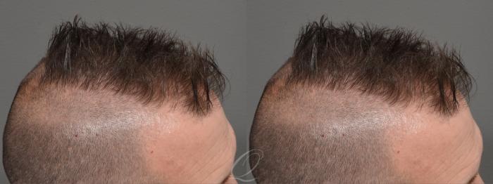 Male FUE Hair Transplant Case 1001691 Before & After Right Side | Serving Rochester, Syracuse & Buffalo, NY | Quatela Center for Plastic Surgery
