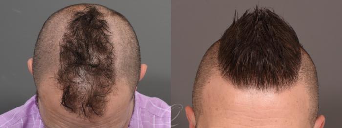 Male FUE Hair Transplant Case 1001691 Before & After Top View | Serving Rochester, Syracuse & Buffalo, NY | Quatela Center for Plastic Surgery