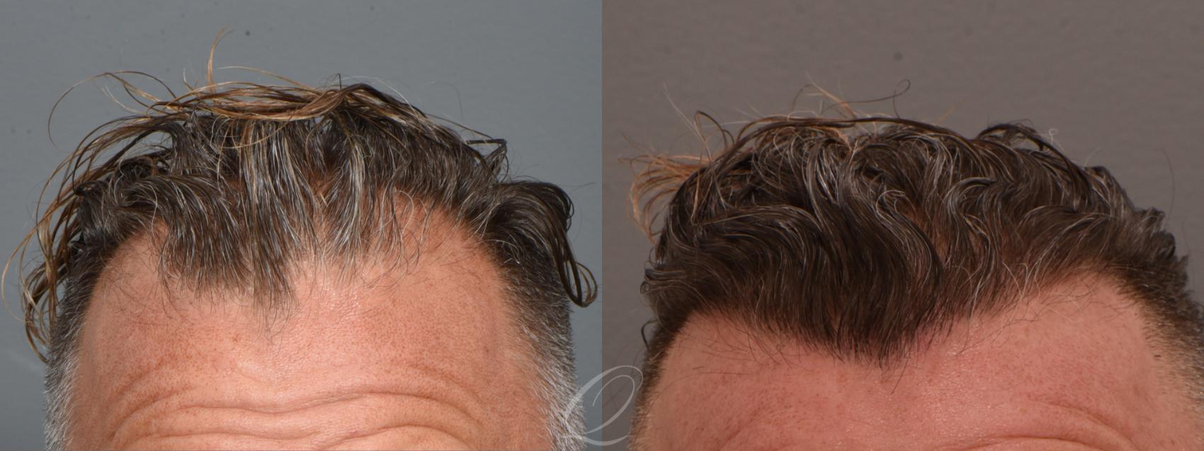 Male Hairline and Central Density Hair Restoration Case 1001692 Before & After Front | Serving Rochester, Syracuse & Buffalo, NY | Quatela Center for Plastic Surgery