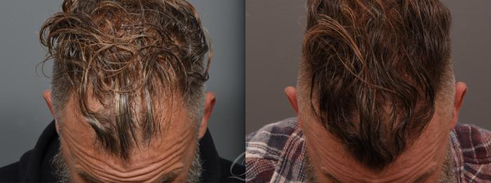 Male FUE Hair Transplant Case 1001692 Before & After Top View | Serving Rochester, Syracuse & Buffalo, NY | Quatela Center for Plastic Surgery