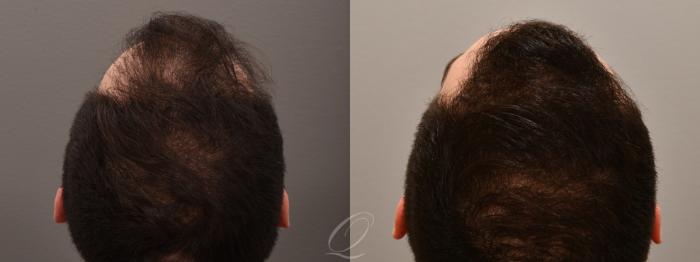 Male FUE Hair Transplant Case 1001693 Before & After Back | Serving Rochester, Syracuse & Buffalo, NY | Quatela Center for Plastic Surgery