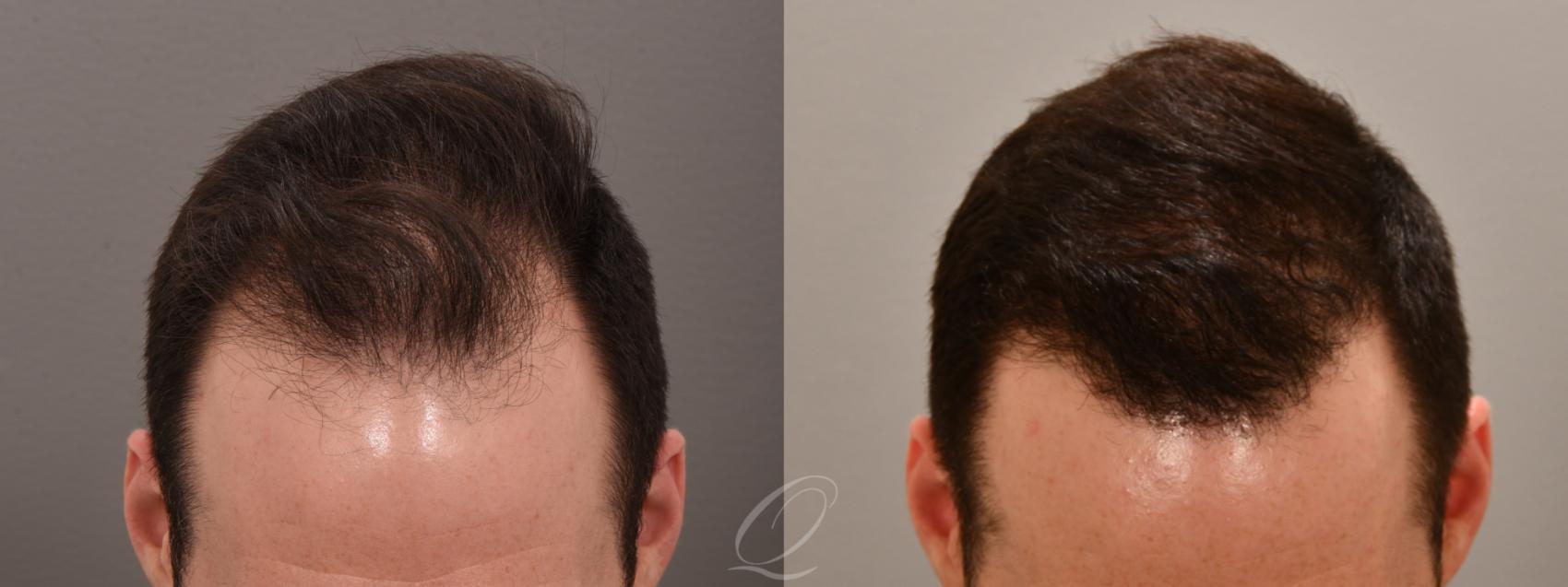 Male FUE Hair Transplant Case 1001693 Before & After Front | Serving Rochester, Syracuse & Buffalo, NY | Quatela Center for Plastic Surgery