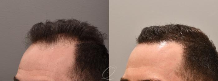 Male FUE Hair Transplant Case 1001693 Before & After Left Oblique | Serving Rochester, Syracuse & Buffalo, NY | Quatela Center for Plastic Surgery