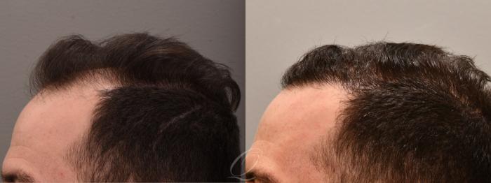 Male FUE Hair Transplant Case 1001693 Before & After Left Side | Serving Rochester, Syracuse & Buffalo, NY | Quatela Center for Plastic Surgery