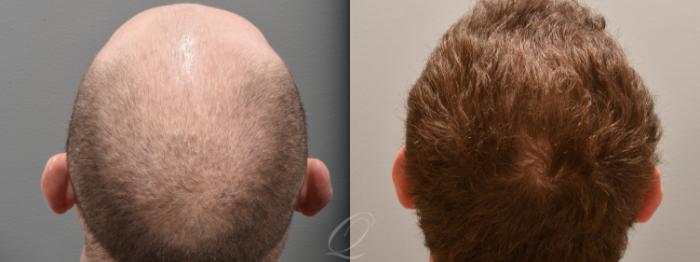 Male FUE Hair Transplant Case 1001695 Before & After Back | Serving Rochester, Syracuse & Buffalo, NY | Quatela Center for Plastic Surgery