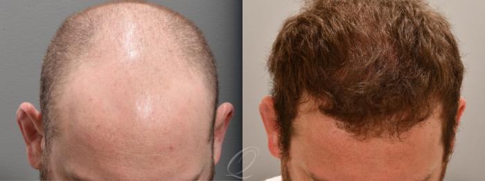 Male FUE Hair Transplant Case 1001695 Before & After Front | Serving Rochester, Syracuse & Buffalo, NY | Quatela Center for Plastic Surgery