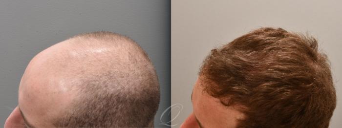 Male FUE Hair Transplant Case 1001695 Before & After Right Side | Serving Rochester, Syracuse & Buffalo, NY | Quatela Center for Plastic Surgery