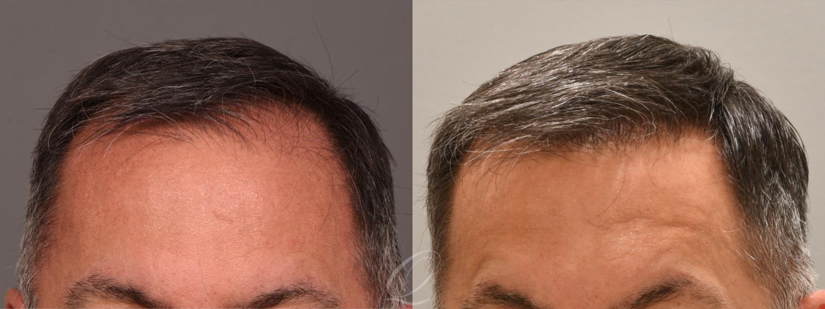 Male FUE Hair Transplant Case 1001713 Before & After Front | Serving Rochester, Syracuse & Buffalo, NY | Quatela Center for Plastic Surgery