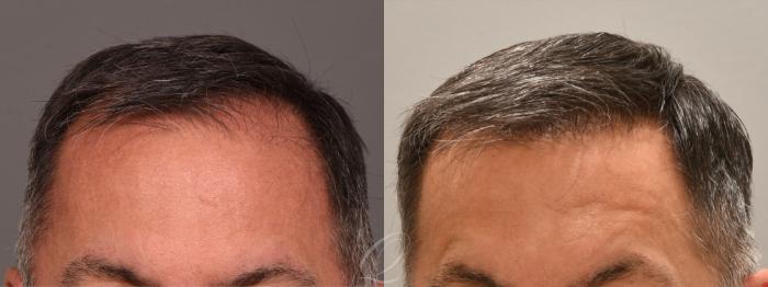 Male FUE Hair Transplant Case 1001713 Before & After Front | Serving Rochester, Syracuse & Buffalo, NY | Quatela Center for Plastic Surgery