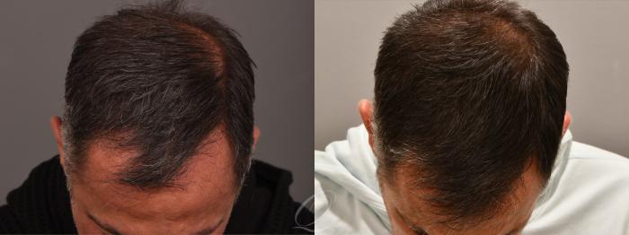 Before & After Male FUE Hair Transplant Case 1001713 Head down View in Rochester, Buffalo, & Syracuse, NY