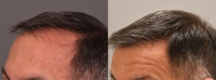 Before & After Male FUE Hair Transplant Case 1001713 Left Oblique View in Rochester, Buffalo, & Syracuse, NY