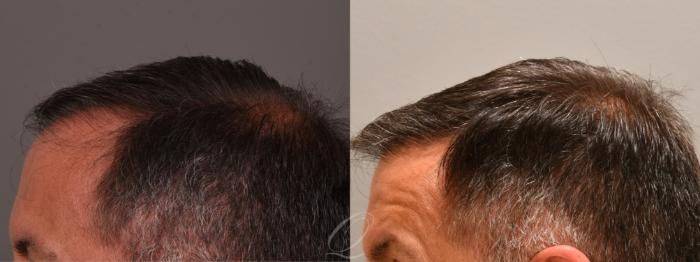 Before & After Male FUE Hair Transplant Case 1001713 Left Side View in Rochester, Buffalo, & Syracuse, NY