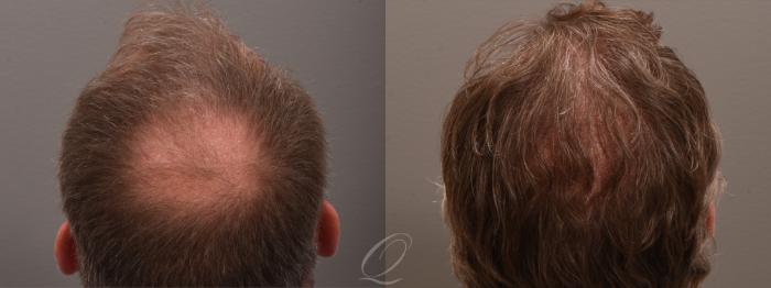 Before & After PRP Injections Case 1001816 Back View in Rochester, Buffalo, & Syracuse, NY