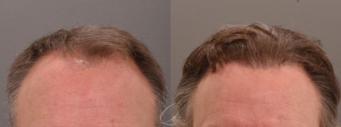 Male FUE Hair Transplant Case 1001816 Before & After Front | Serving Rochester, Syracuse & Buffalo, NY | Quatela Center for Plastic Surgery