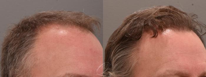 Before & After PRP Injections Case 1001816 Left Side View in Rochester, Buffalo, & Syracuse, NY