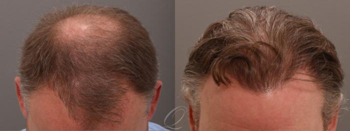 Before & After PRP Injections Case 1001816 Top of Head  View in Rochester, Buffalo, & Syracuse, NY