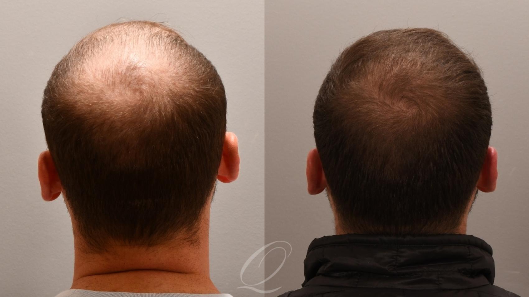 Male FUE Hair Transplant Case 1001832 Before & After Back | Serving Rochester, Syracuse & Buffalo, NY | Quatela Center for Plastic Surgery