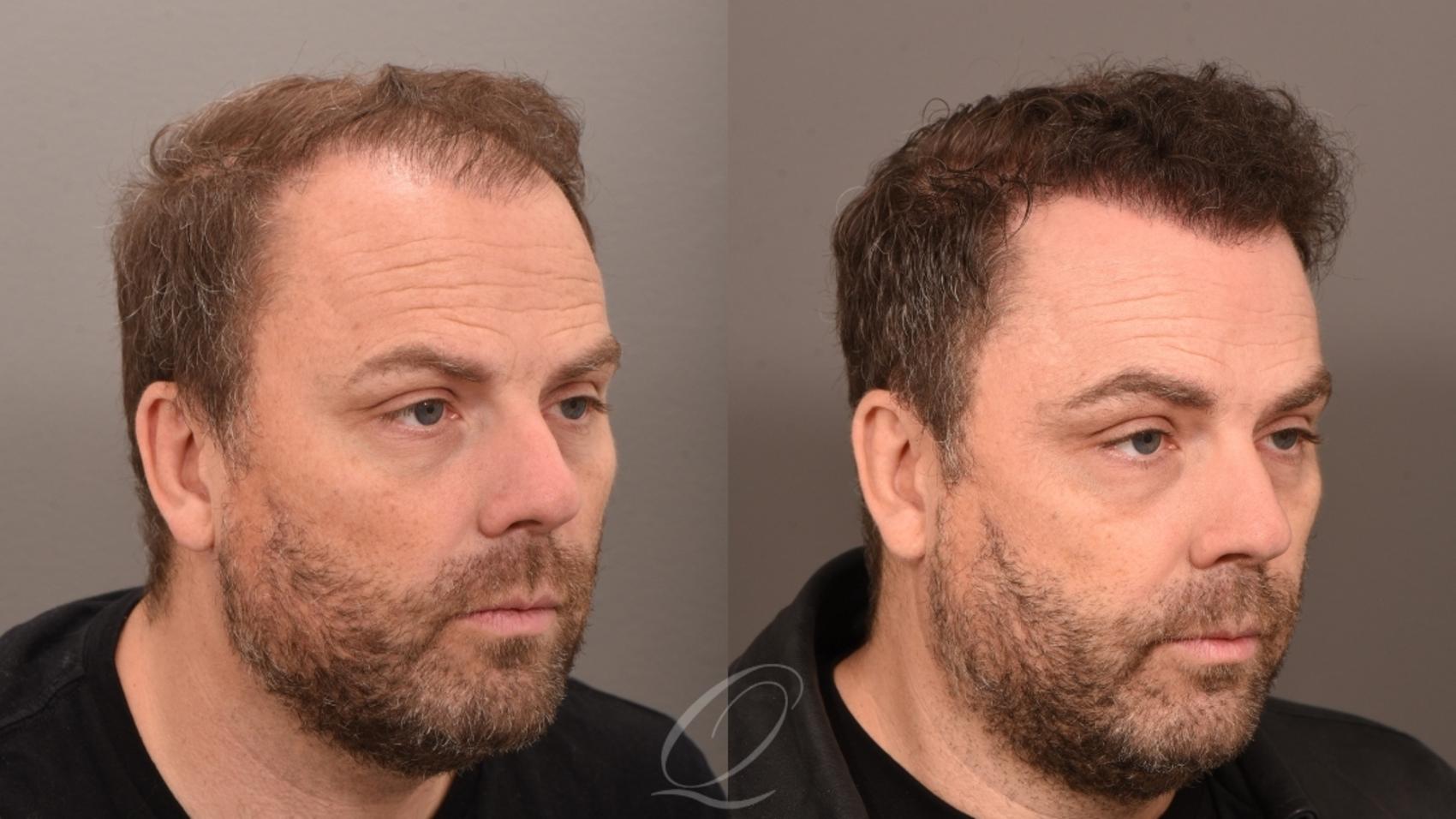 Male FUE Hair Transplant Case 1001833 Before & After Left Side | Serving Rochester, Syracuse & Buffalo, NY | Quatela Center for Plastic Surgery