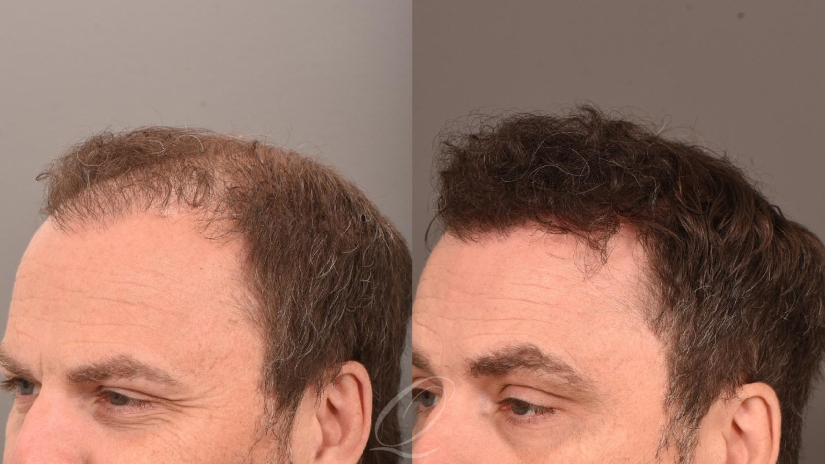 Male FUE Hair Transplant Case 1001833 Before & After Right Side | Serving Rochester, Syracuse & Buffalo, NY | Quatela Center for Plastic Surgery