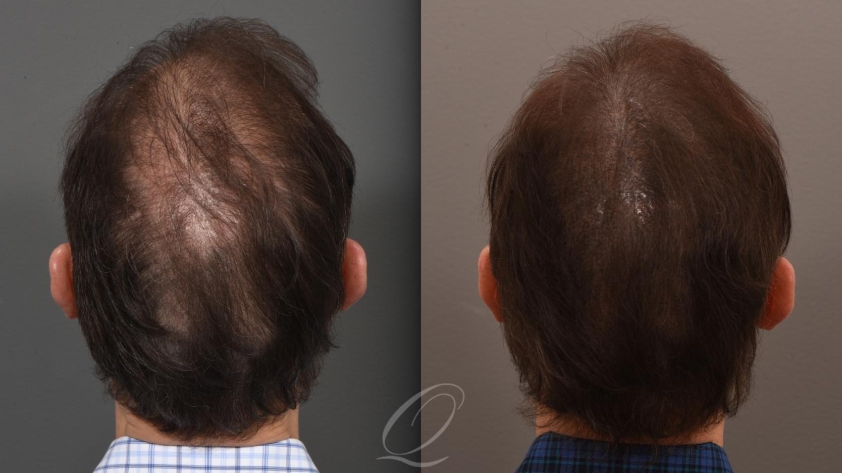 Male FUE Hair Transplant Case 1001844 Before & After Back | Serving Rochester, Syracuse & Buffalo, NY | Quatela Center for Plastic Surgery