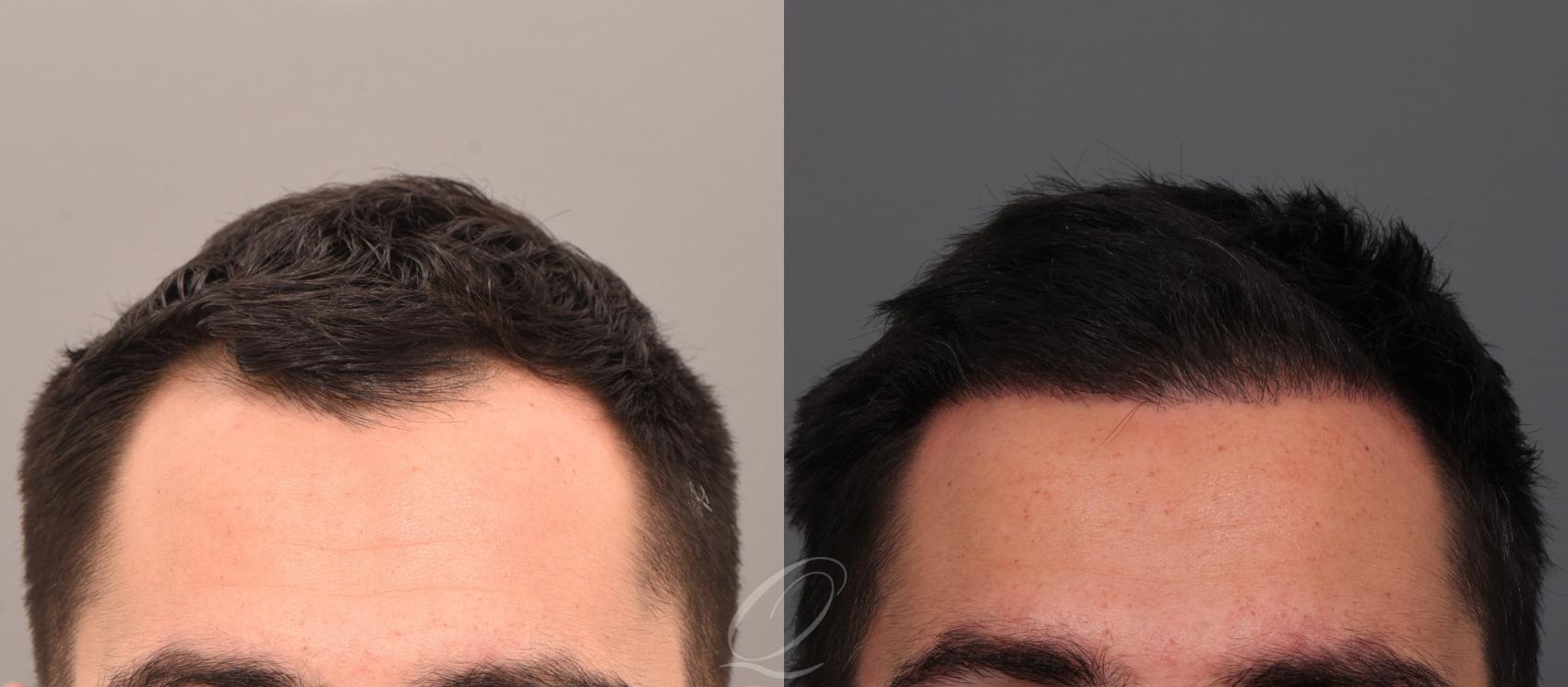 Male FUE Hair Transplant Case 1001882 Before & After Front | Serving Rochester, Syracuse & Buffalo, NY | Quatela Center for Plastic Surgery
