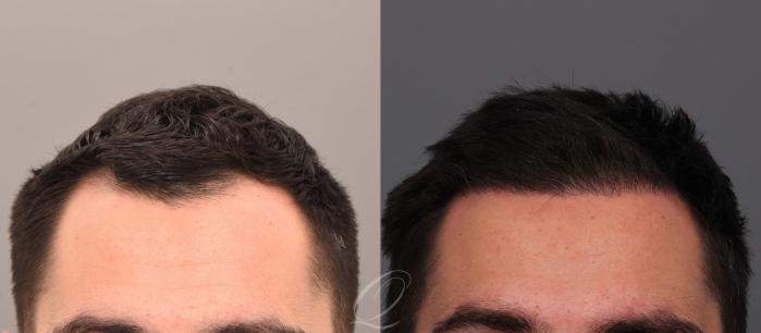 Male FUE Hair Transplant Case 1001882 Before & After Front | Serving Rochester, Syracuse & Buffalo, NY | Quatela Center for Plastic Surgery