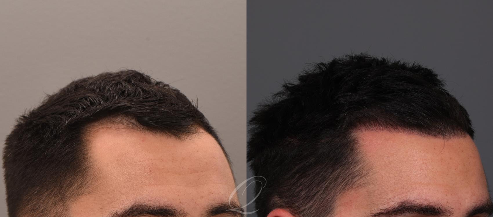 Male FUE Hair Transplant Case 1001882 Before & After Left Side | Serving Rochester, Syracuse & Buffalo, NY | Quatela Center for Plastic Surgery