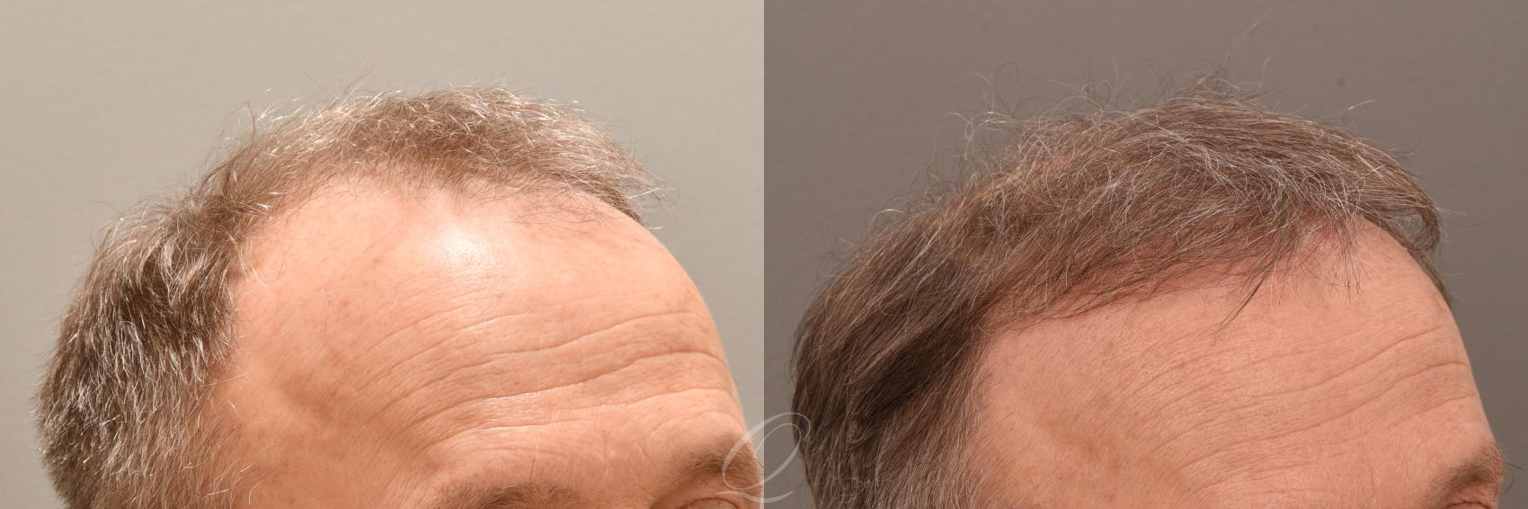 Male FUE Hair Transplant Case 1001883 Before & After Left Side | Serving Rochester, Syracuse & Buffalo, NY | Quatela Center for Plastic Surgery
