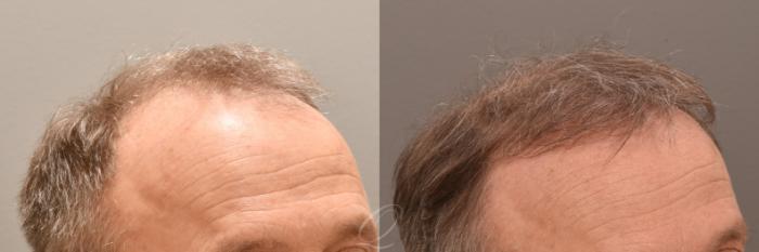 Before & After Male FUE Hair Transplant Case 1001883 Left Side View in Rochester, Buffalo, & Syracuse, NY