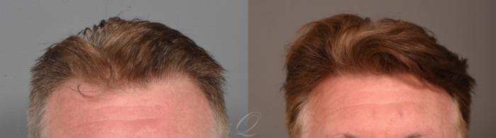PRP Injections Case 1001896 Before & After Front | Serving Rochester, Syracuse & Buffalo, NY | Quatela Center for Plastic Surgery