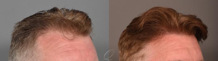 PRP Injections Case 1001896 Before & After Left Side | Serving Rochester, Syracuse & Buffalo, NY | Quatela Center for Plastic Surgery