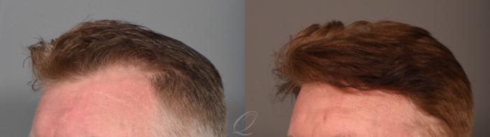 PRP Injections Case 1001896 Before & After Right Oblique | Serving Rochester, Syracuse & Buffalo, NY | Quatela Center for Plastic Surgery