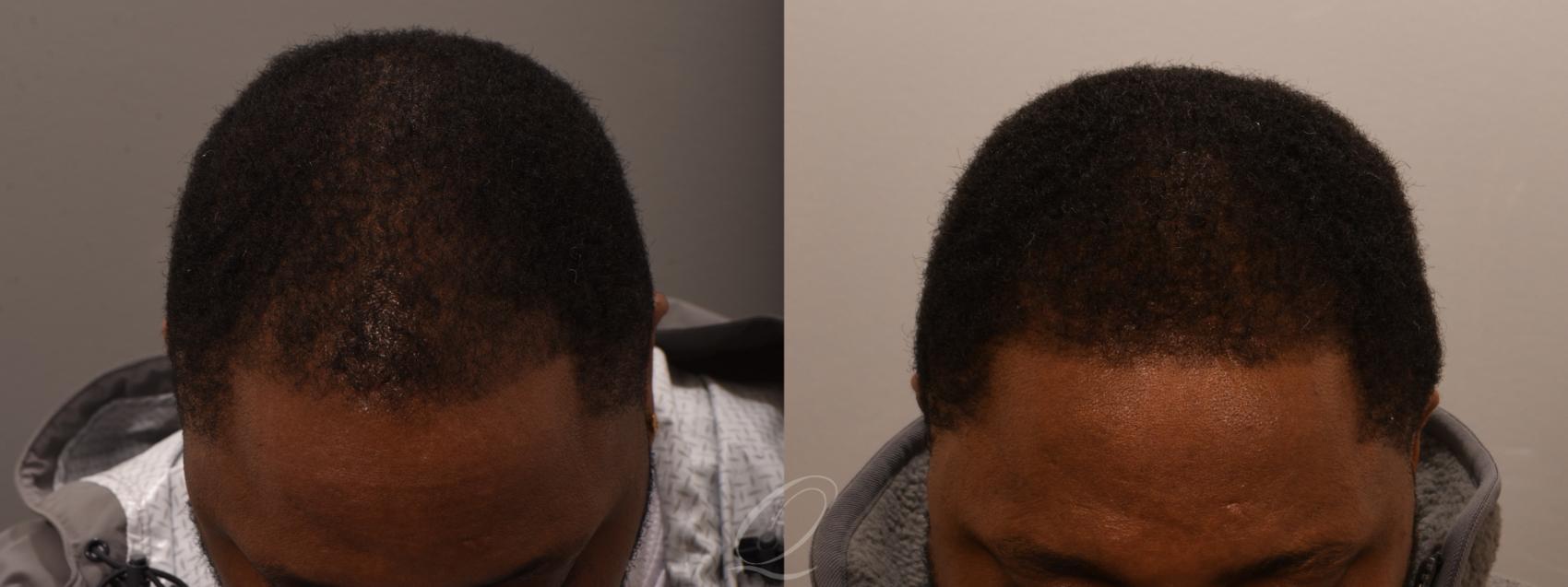 Male FUE Hair Transplant Case 1001916 Before & After Front | Serving Rochester, Syracuse & Buffalo, NY | Quatela Center for Plastic Surgery