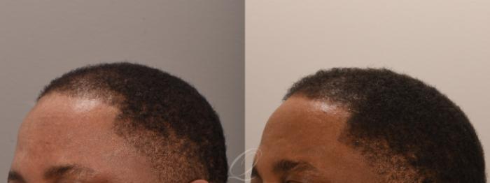 Male FUE Hair Transplant Case 1001916 Before & After Left Oblique | Serving Rochester, Syracuse & Buffalo, NY | Quatela Center for Plastic Surgery