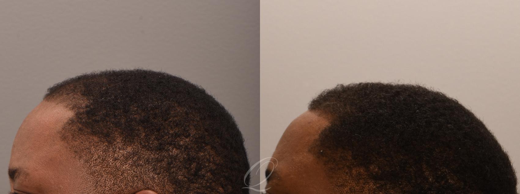 Male FUE Hair Transplant Case 1001916 Before & After Left Side | Serving Rochester, Syracuse & Buffalo, NY | Quatela Center for Plastic Surgery