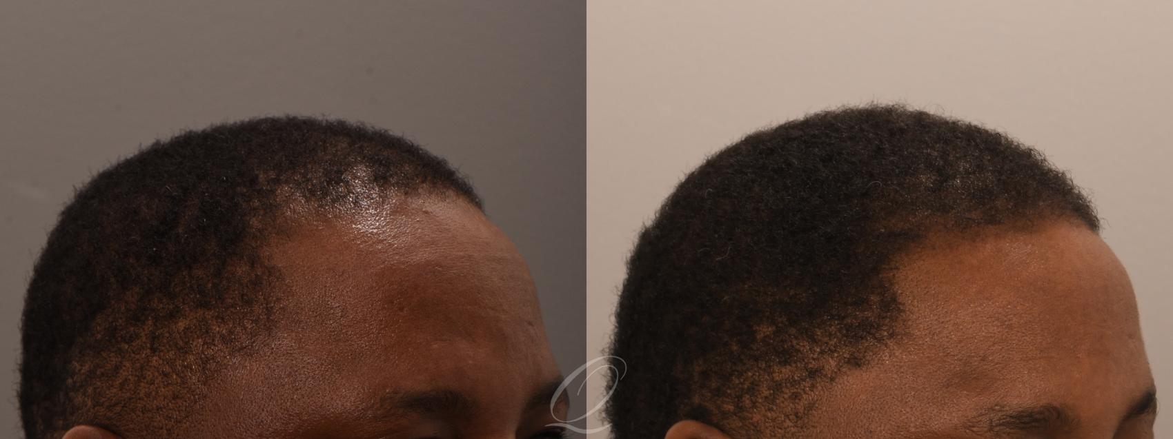 Male FUE Hair Transplant Case 1001916 Before & After Right Oblique | Serving Rochester, Syracuse & Buffalo, NY | Quatela Center for Plastic Surgery