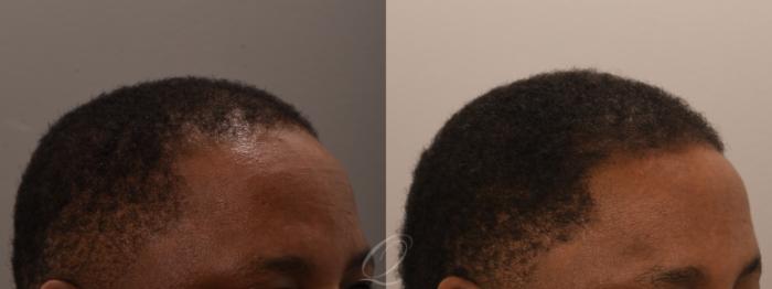 Male FUE Hair Transplant Case 1001916 Before & After Right Oblique | Serving Rochester, Syracuse & Buffalo, NY | Quatela Center for Plastic Surgery