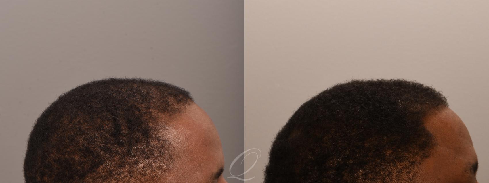 Male FUE Hair Transplant Case 1001916 Before & After Right Side | Serving Rochester, Syracuse & Buffalo, NY | Quatela Center for Plastic Surgery