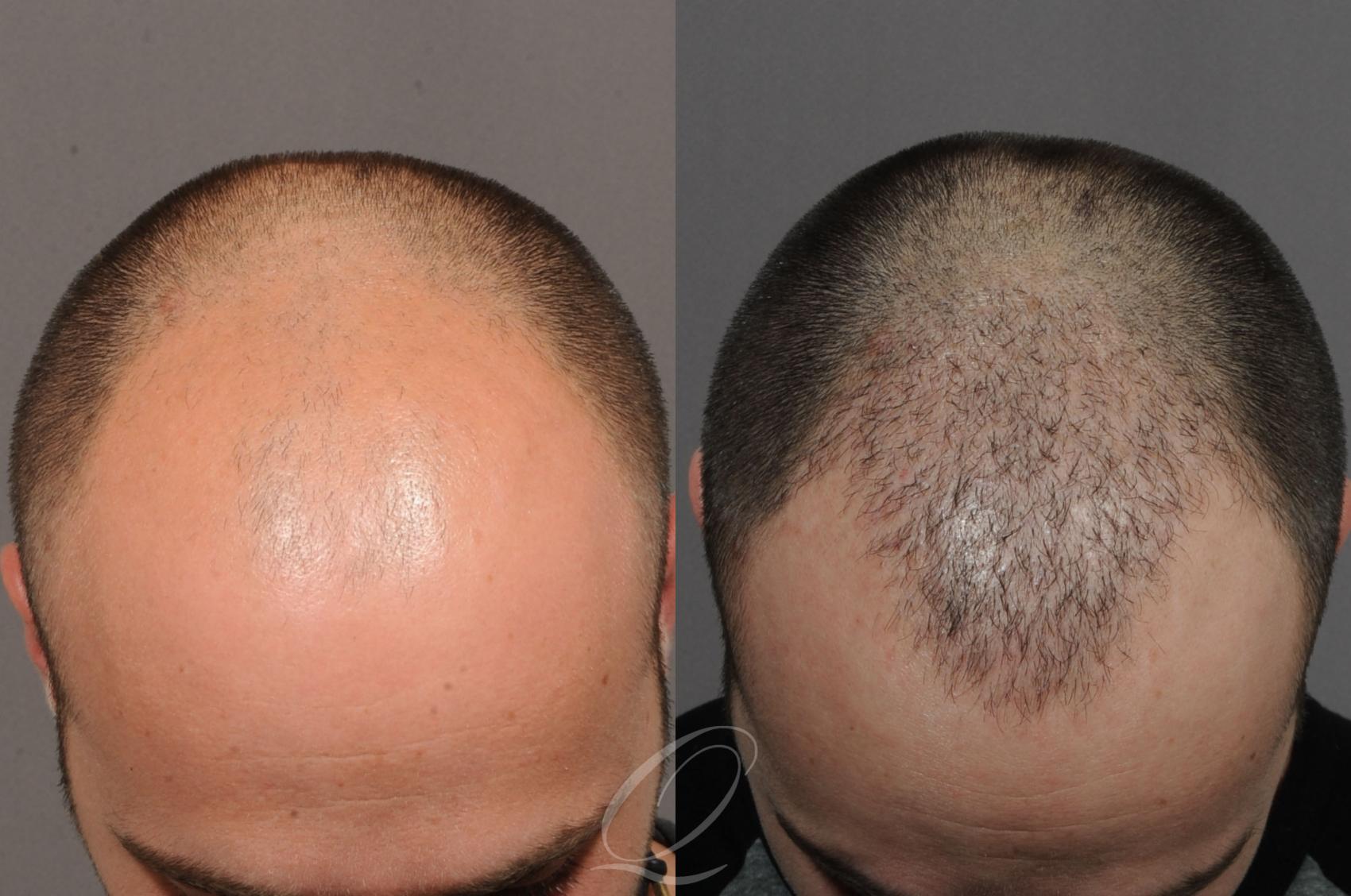 Male Hairline and Central Density Hair Restoration Case 1055 Before & After View #1 | Rochester, Buffalo, & Syracuse, NY | Quatela Center for Hair Restoration