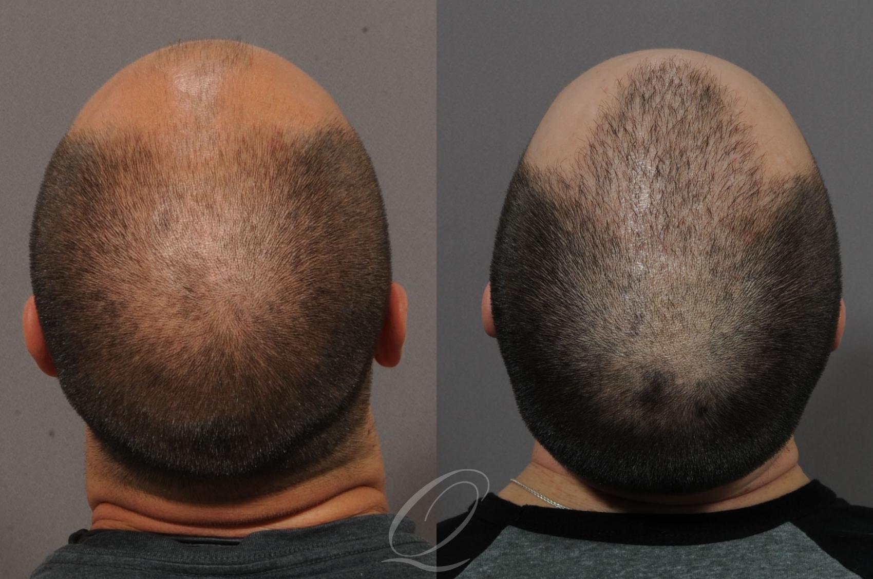 Male FUE Hair Transplant Before & After Photos Patient 1055 | Rochester,  Buffalo, & Syracuse, NY | Quatela Center for Hair Restoration